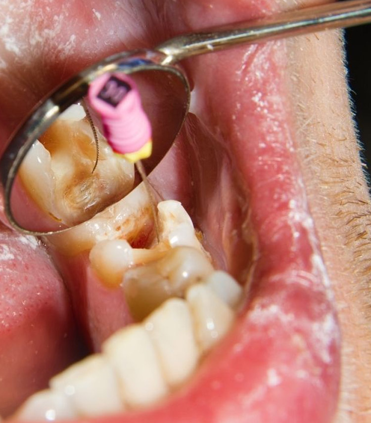 Poli P S Gradua O Em Odontologia Endodontia Tratamento De Canal