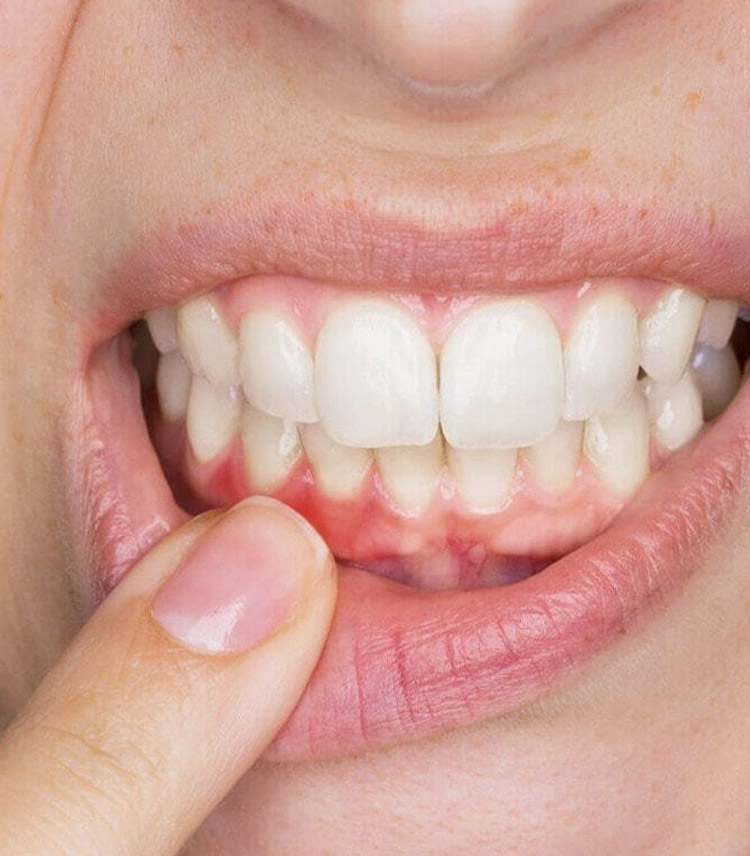 Periodontia - tratamento das gengivas 